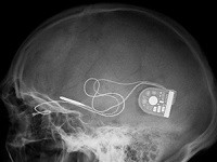 Bežično kontrolisani mikročip povratio ograničen vid u eksperimentalnom ispitivanju naslovna bezicno_kontrolisani_mikrocip_povratio_ogranicen_vid_u_eksperimentalnom_ispitivanju_vesti_obrada_signala_automatika.rs