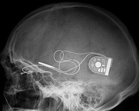 Bežično kontrolisani mikročip povratio ograničen vid u eksperimentalnom ispitivanju naslovna bezicno_kontrolisani_mikrocip_povratio_ogranicen_vid_u_eksperimentalnom_ispitivanju_vesti_obrada_signala_automatika.rs