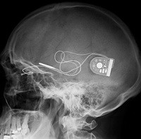 Bežično kontrolisani mikročip povratio ograničen vid u eksperimentalnom ispitivanju naslovna bezicno_kontrolisani_mikrocip_povratio_ogranicen_vid_u_eksperimentalnom_ispitivanju_vesti_obrada_signala_automatika.rs